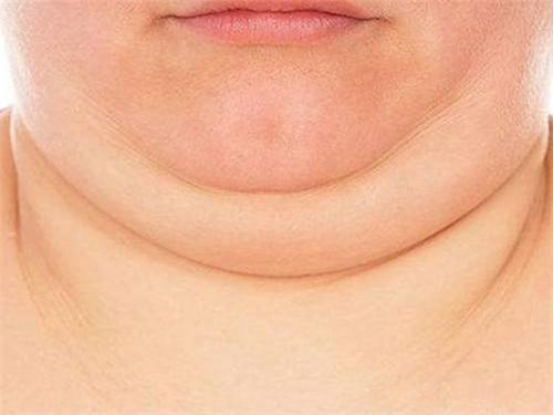 我们都知道偏胖的人会容易出现双下巴,加之下巴本身就更容易堆积脂肪.
