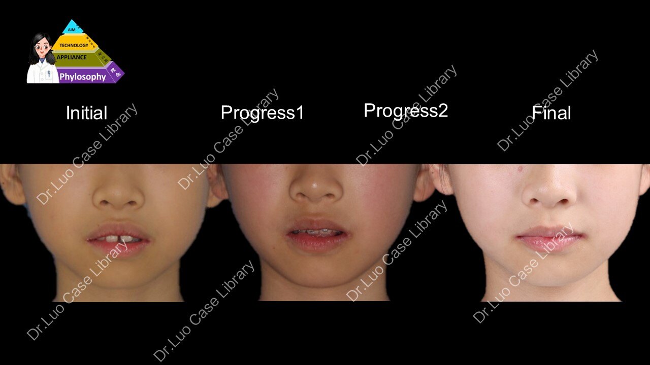 龅牙矫正 龅牙矫正 开唇露齿矫正_牙颌畸形_牙颌畸形治疗方式 - 好