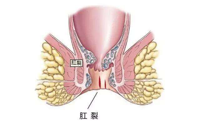 肛裂是怎麼一回事?