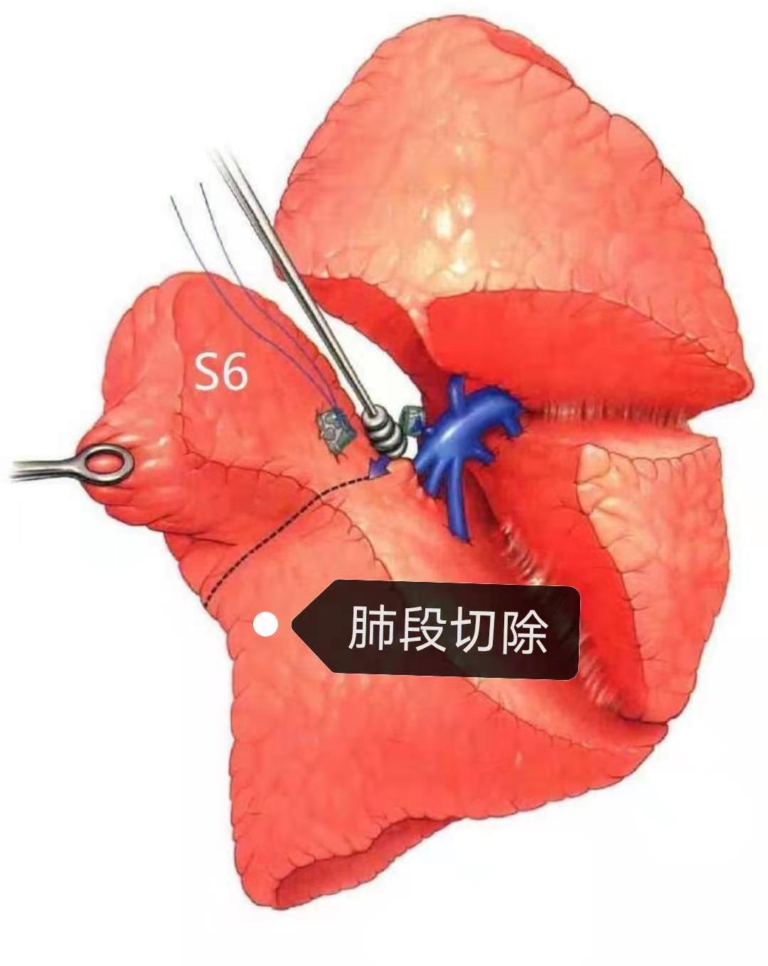肺部常见手术方式楔形切除肺段切除肺叶切除