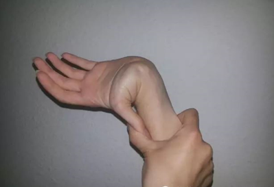 好大夫在线 陈均源 陈均源医生的患友会对于全身性韧带松弛症,目前