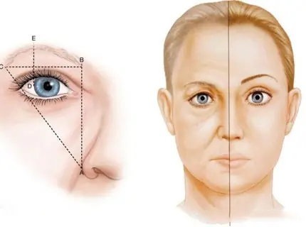 提眉手术恢复期长吗 适应症 会留疤吗 提眉术