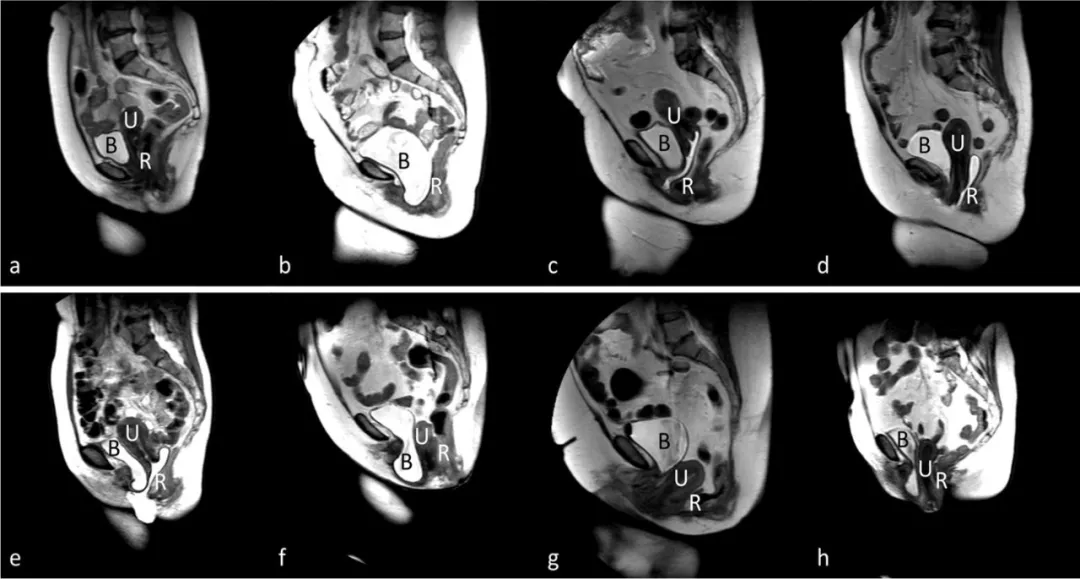磁共振在女性盆腔脏器脱垂中的应用