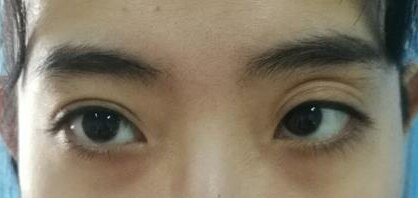 多重技术融合的双眼皮修复术 让 失败重睑 重塑美丽 双眼皮修复 双眼皮修复