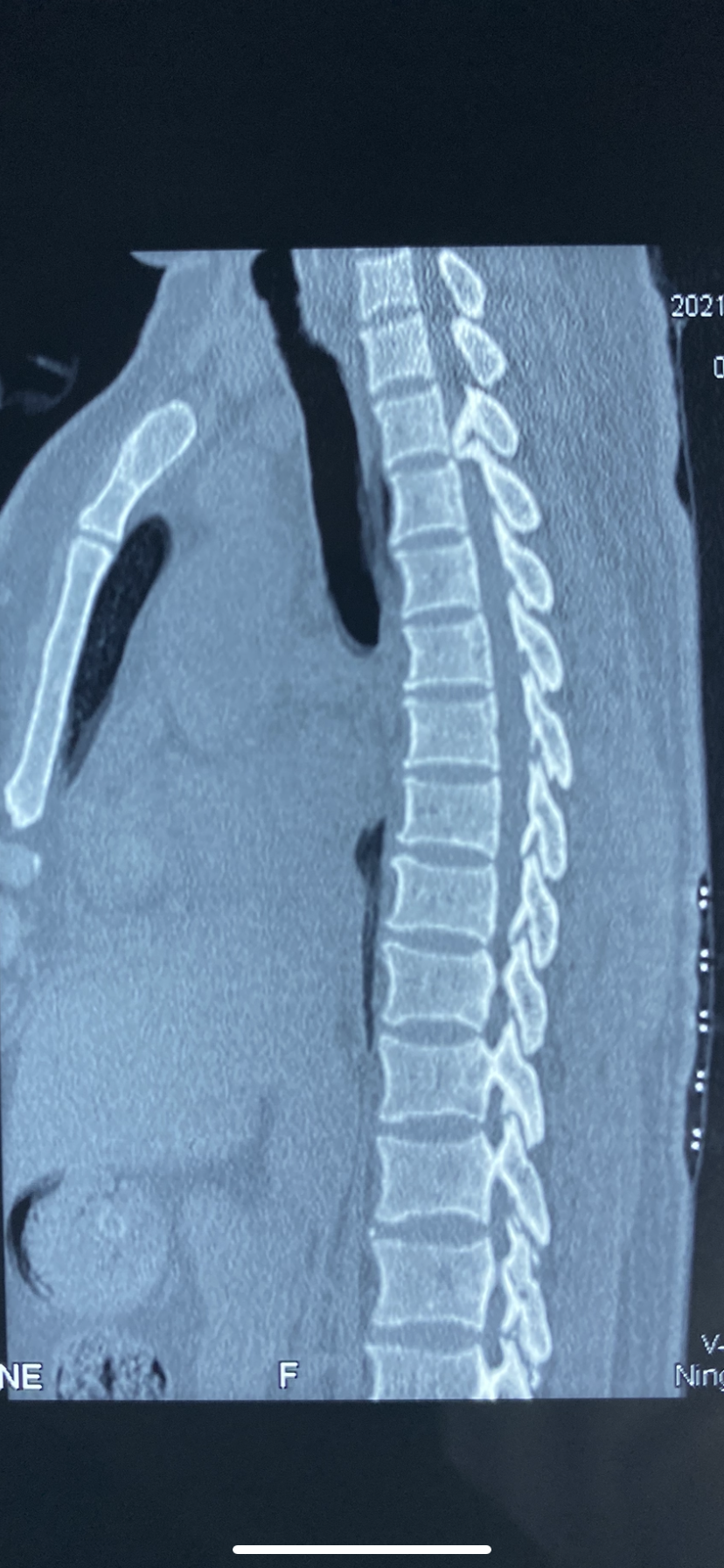 ct显示骨化物占满整个椎管,脊髓严重受压胸椎磁共振显示胸2-3平面黄