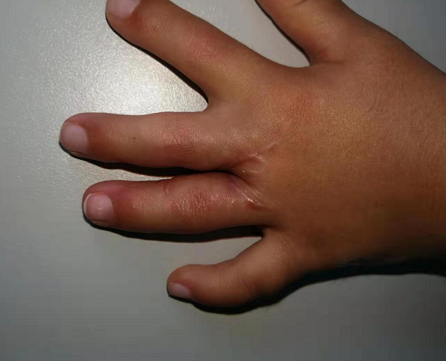 先天性并指多指畸形_先天性并指多指畸形治疗方式 - 好大夫在线