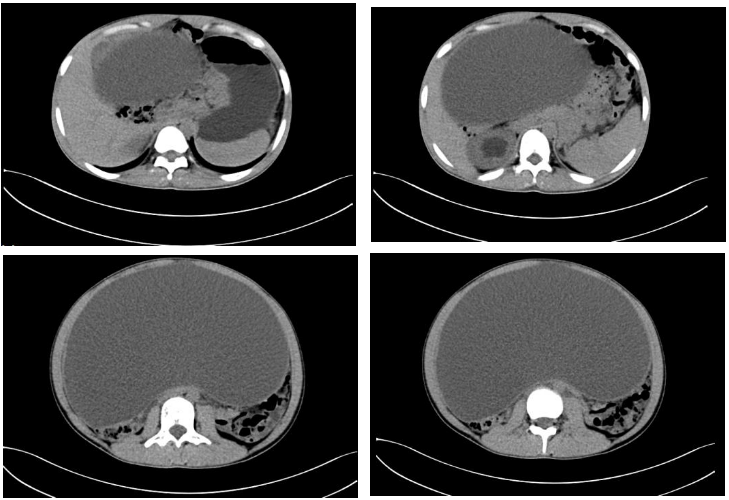 韩丽萍教授团队接连成功完成两例巨大卵巢肿瘤剥除术!单孔"无痕"新时
