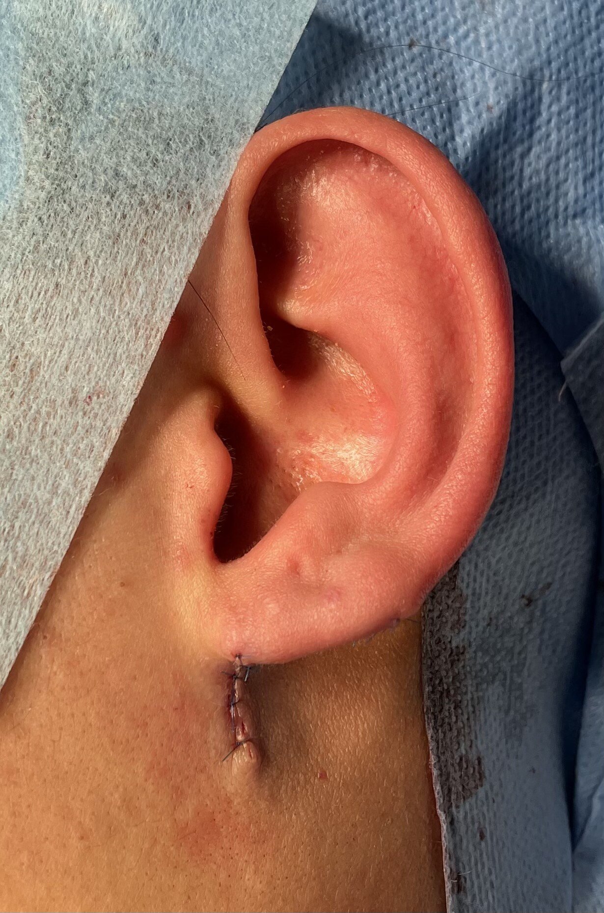 耳垂瘢痕疙瘩图片图片