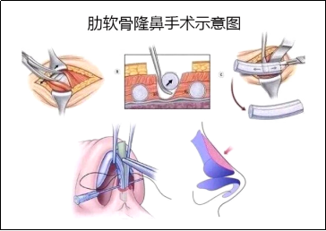 肋软骨隆鼻真的有那么好吗?隆鼻前必看的4个真相!_隆鼻 - 好大夫在线
