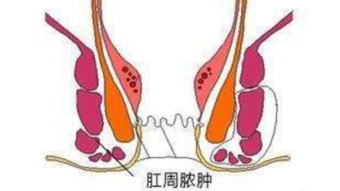 肛周脓肿的病因是什么?