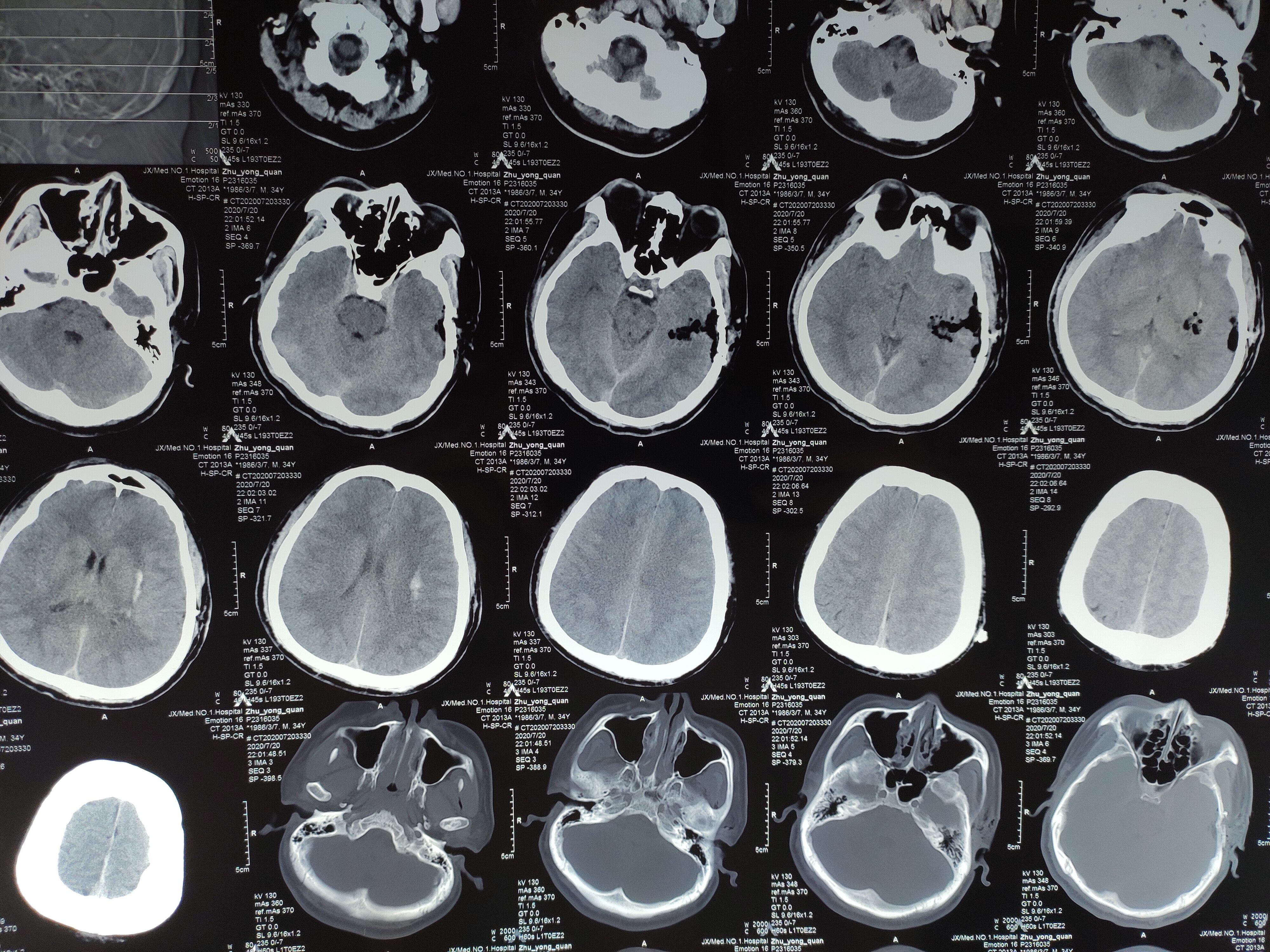 神经内镜微创治疗基底节脑出血-刘越主治 - 好大夫在线