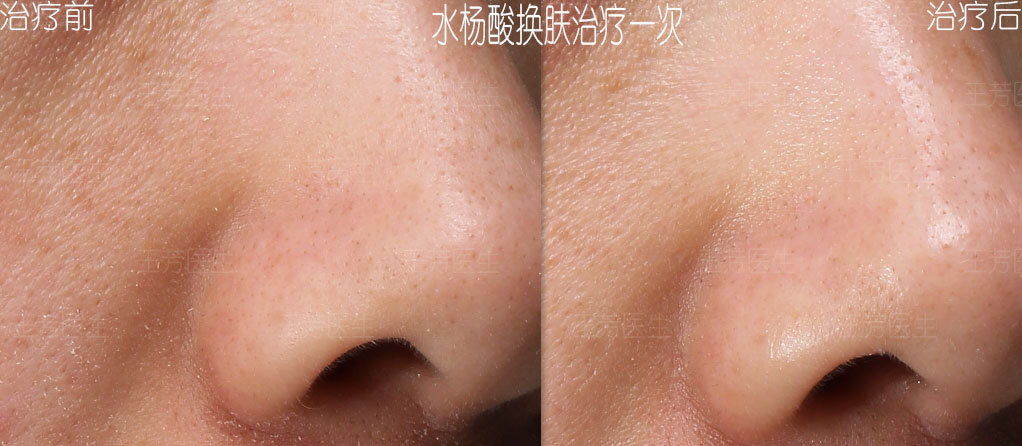 水杨酸换肤治疗 - 好大夫在线