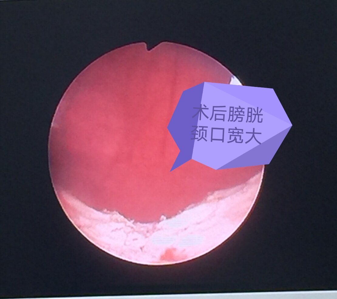 图二    术后膀胱颈口宽大