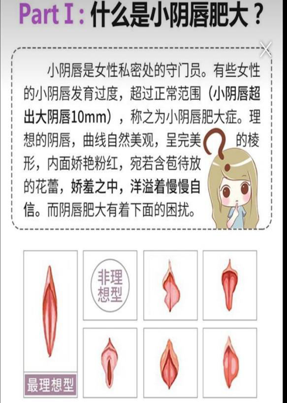 小阴唇整形 整形