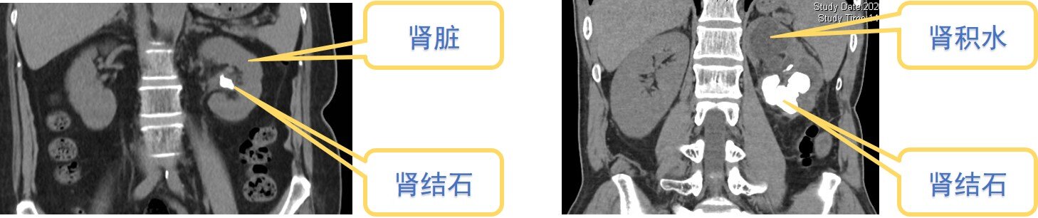 圖-2腎結石與腎積水ct圖(左為腎結石不伴腎積水,右為腎結石伴腎積水和