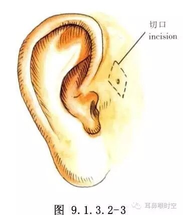 耳前瘘管内部结构图图片