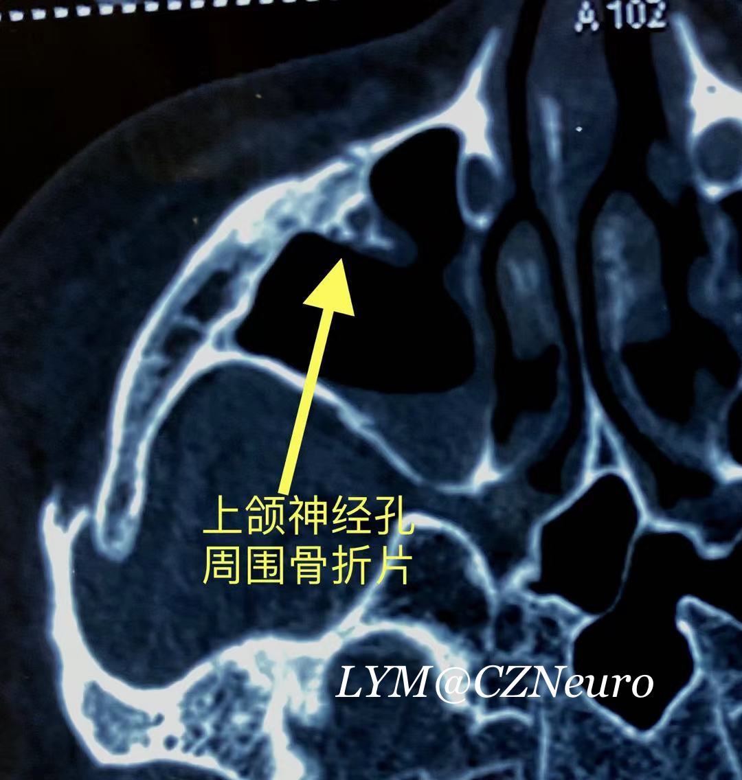 我們用《國際首創--內鏡眶下神經孔減壓術》成功地為一位女士解除痛苦