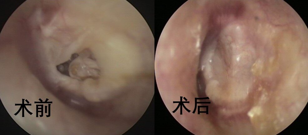 耳膜钙化斑图片