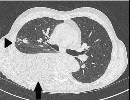 如何用影像学定位胸腔积液_胸腔积液_胸腔积液检查 - 好大夫在线