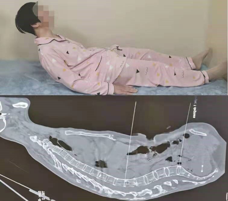 告别十年"罗锅","昂首挺胸"迎来新生