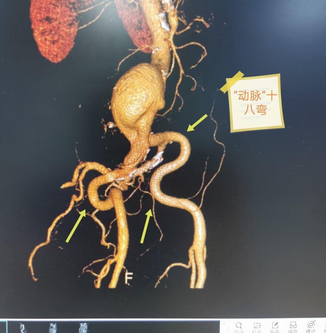 "腿中风",罪魁祸首是肚子里面的巨大右髂动脉瘤 - 好大夫在线