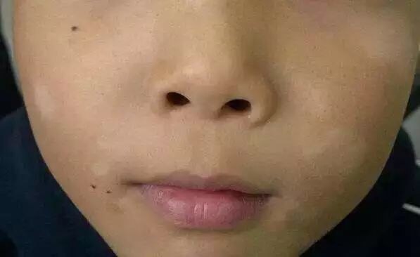 孩子脸上白斑是肚子里有虫缺乏维生素真相是