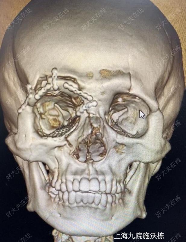 眼眶骨折_眼外伤 - 好大夫在线