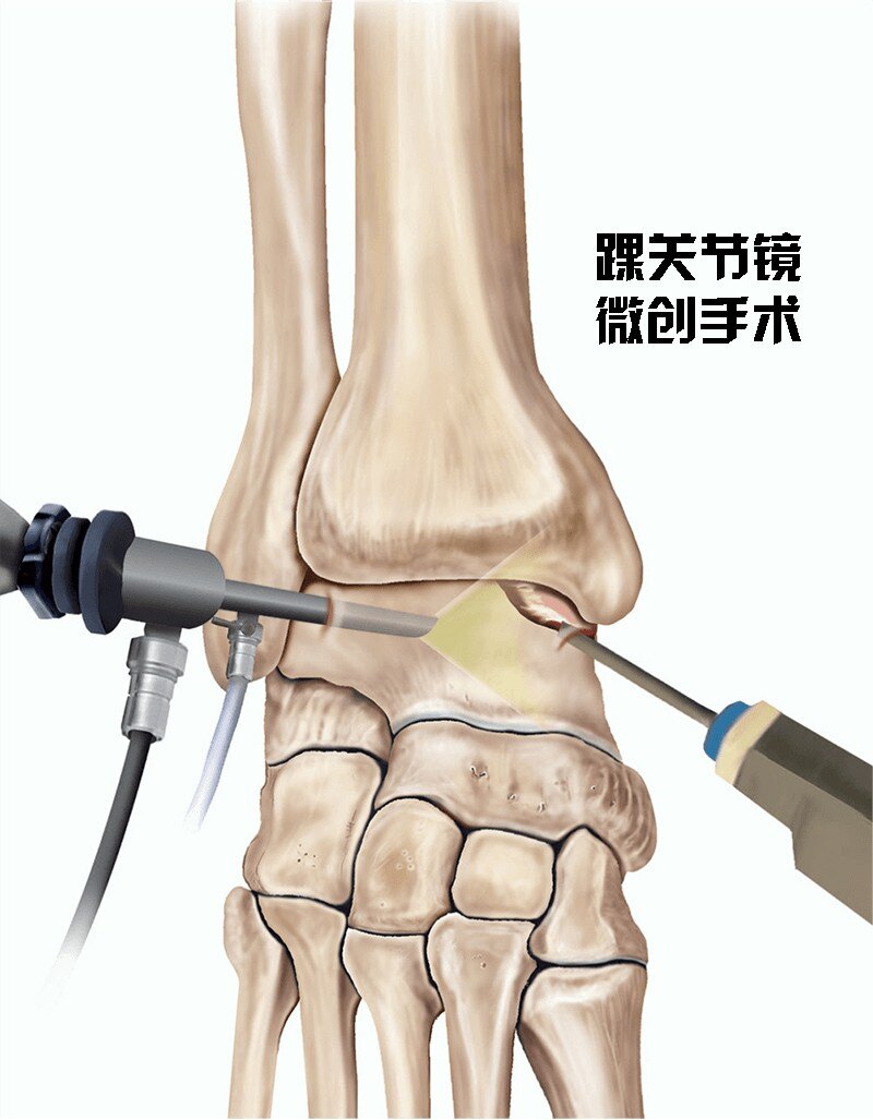 踝关节扭伤怎么治疗?