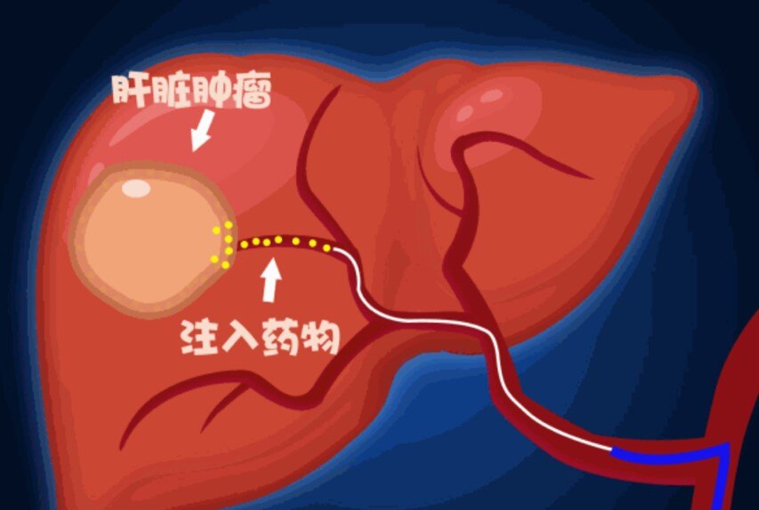 Where is the treatment for liver cancer(肝癌那里治疗好)