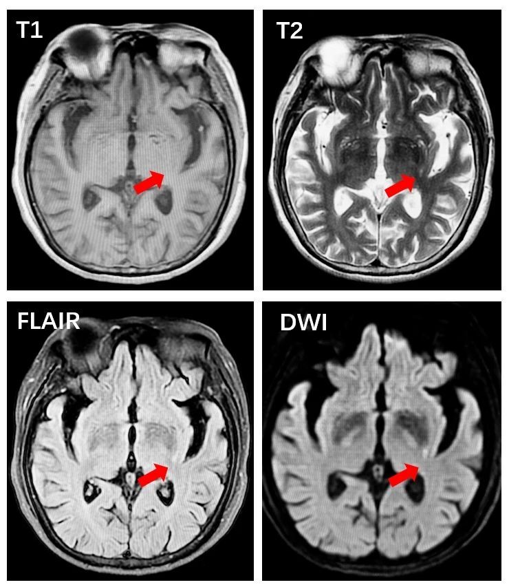 同时发现,患者的头mri的dwi序列上,如下图所示,可见左侧基底节区一个