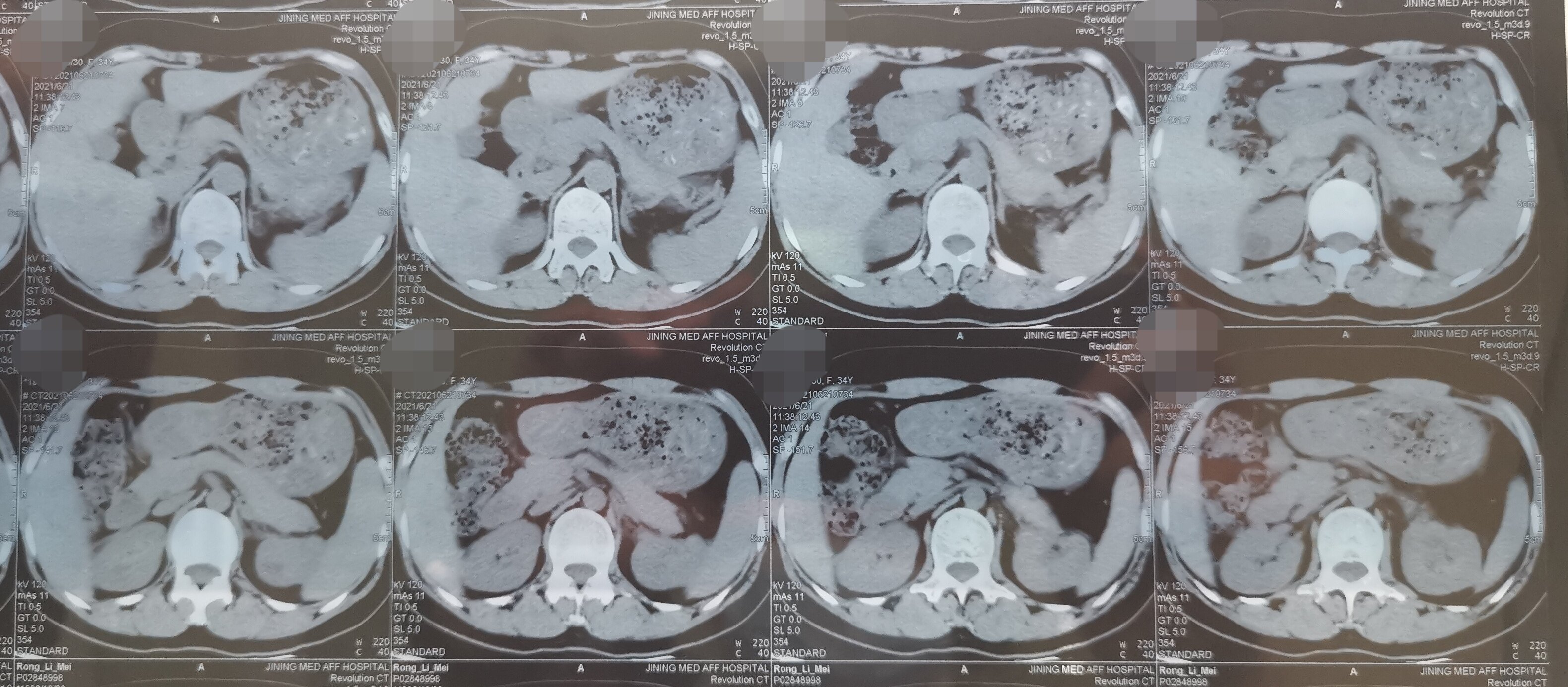 多囊肾患者术后复查,多年的便秘也好了 - 好大夫在线