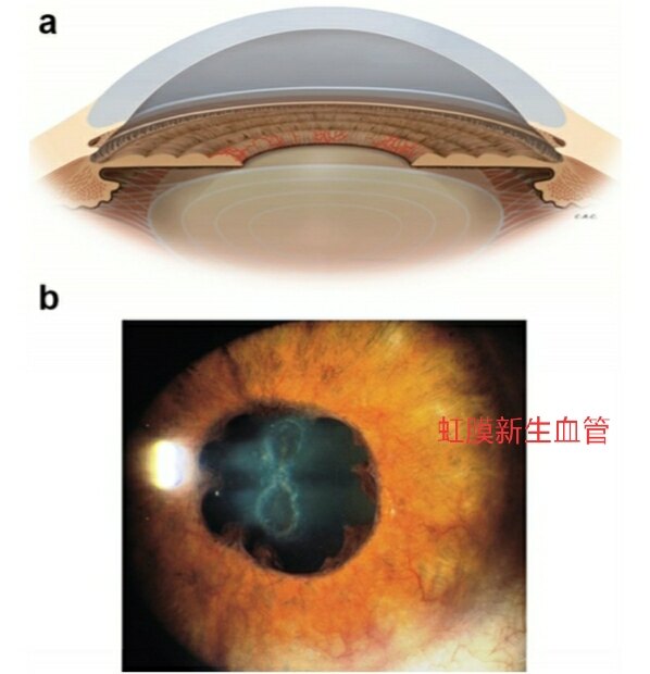 警惕人生最痛苦的青光眼_青光眼_介绍_发病原因_症状表现 - 好大夫