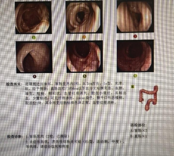 结直肠炎 www.haodf.com