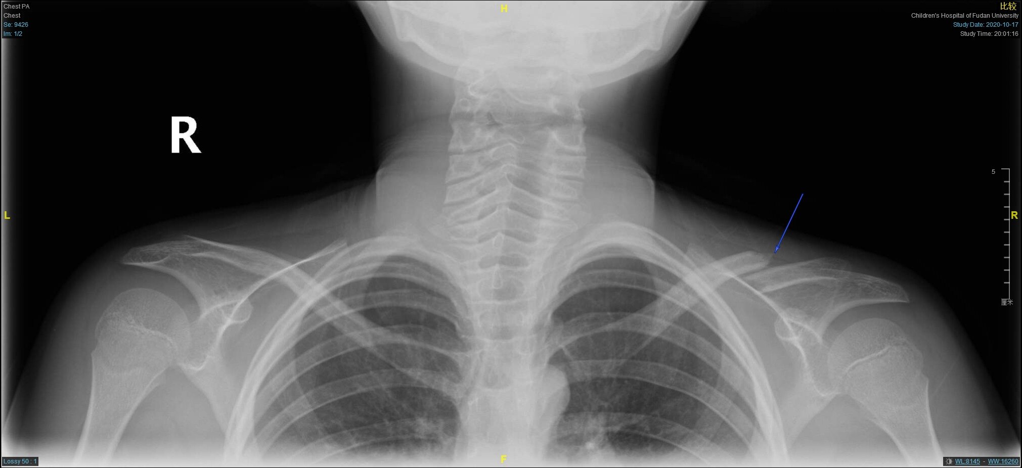 儿童锁骨骨折手术治疗 大于12岁 好大夫在线 儿童锁骨骨折手术治疗 大于12岁 好大夫在线