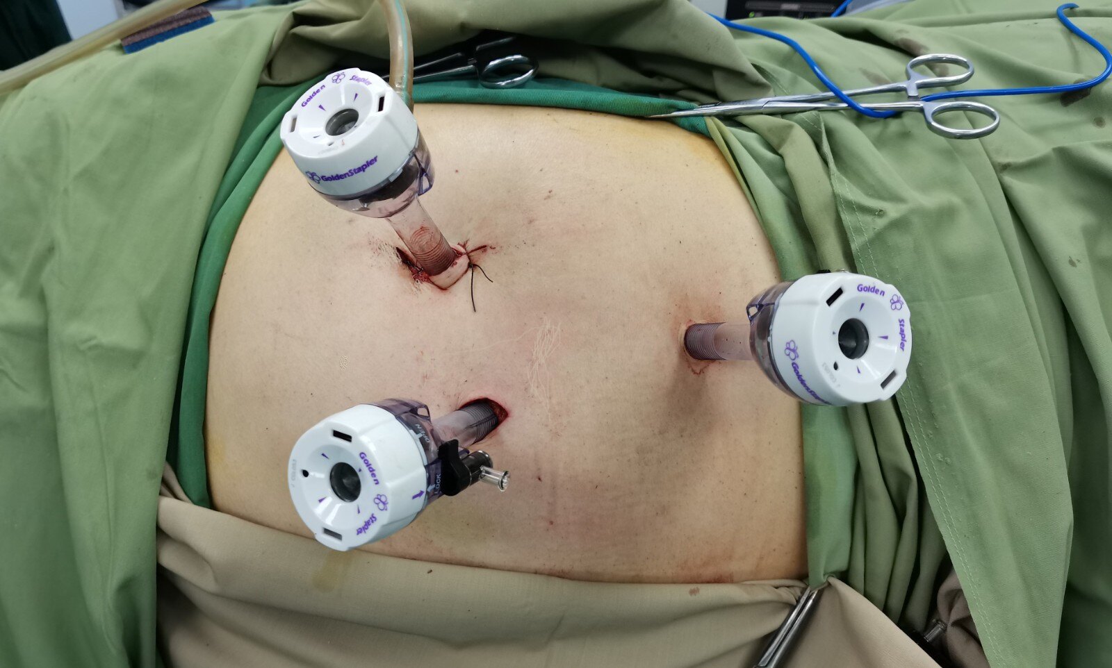 肾脏部分切除作为目前早期肾癌的一种常用手术方式,经过合理的患者