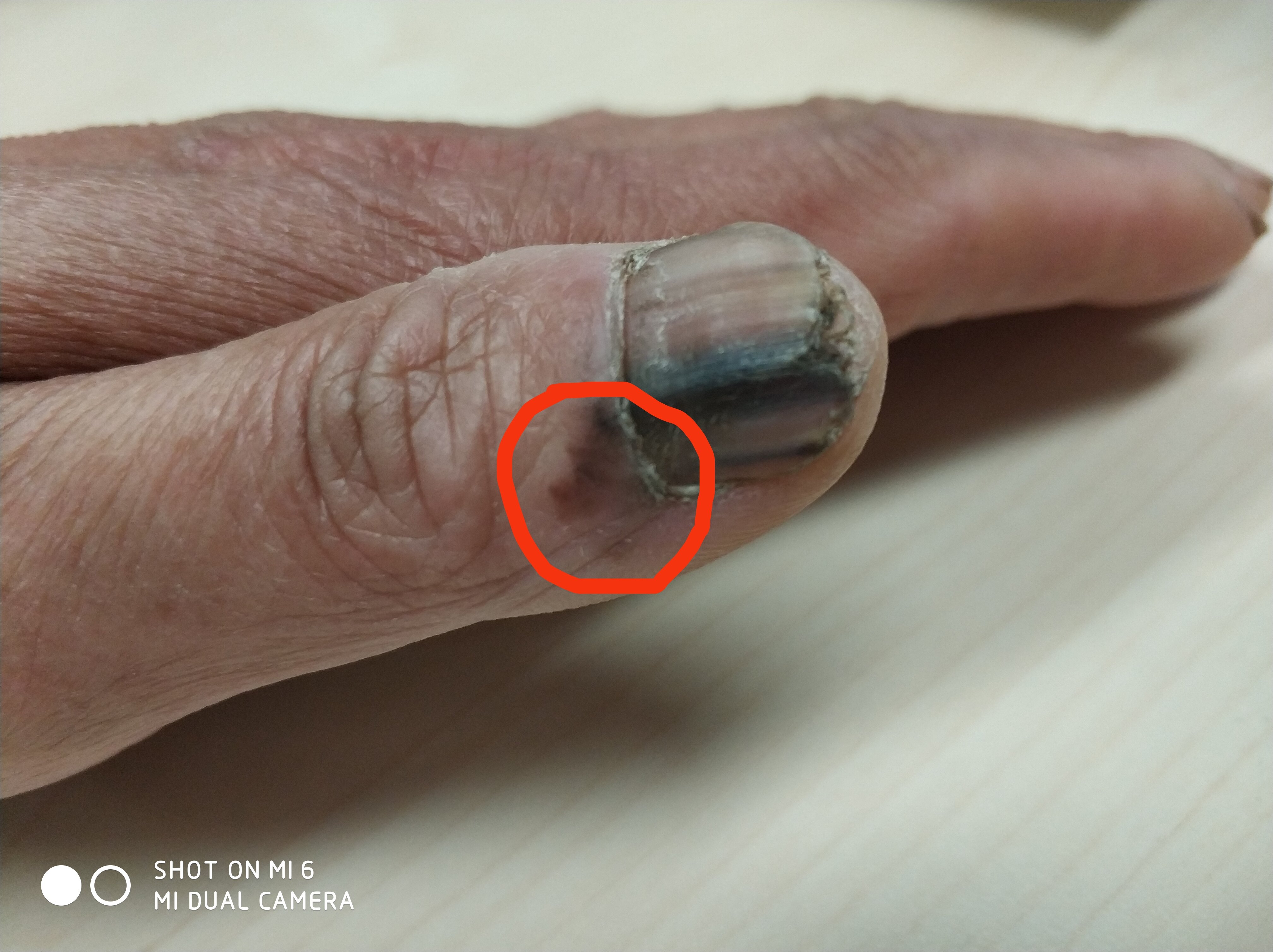 指甲变黑是癌症图片图片
