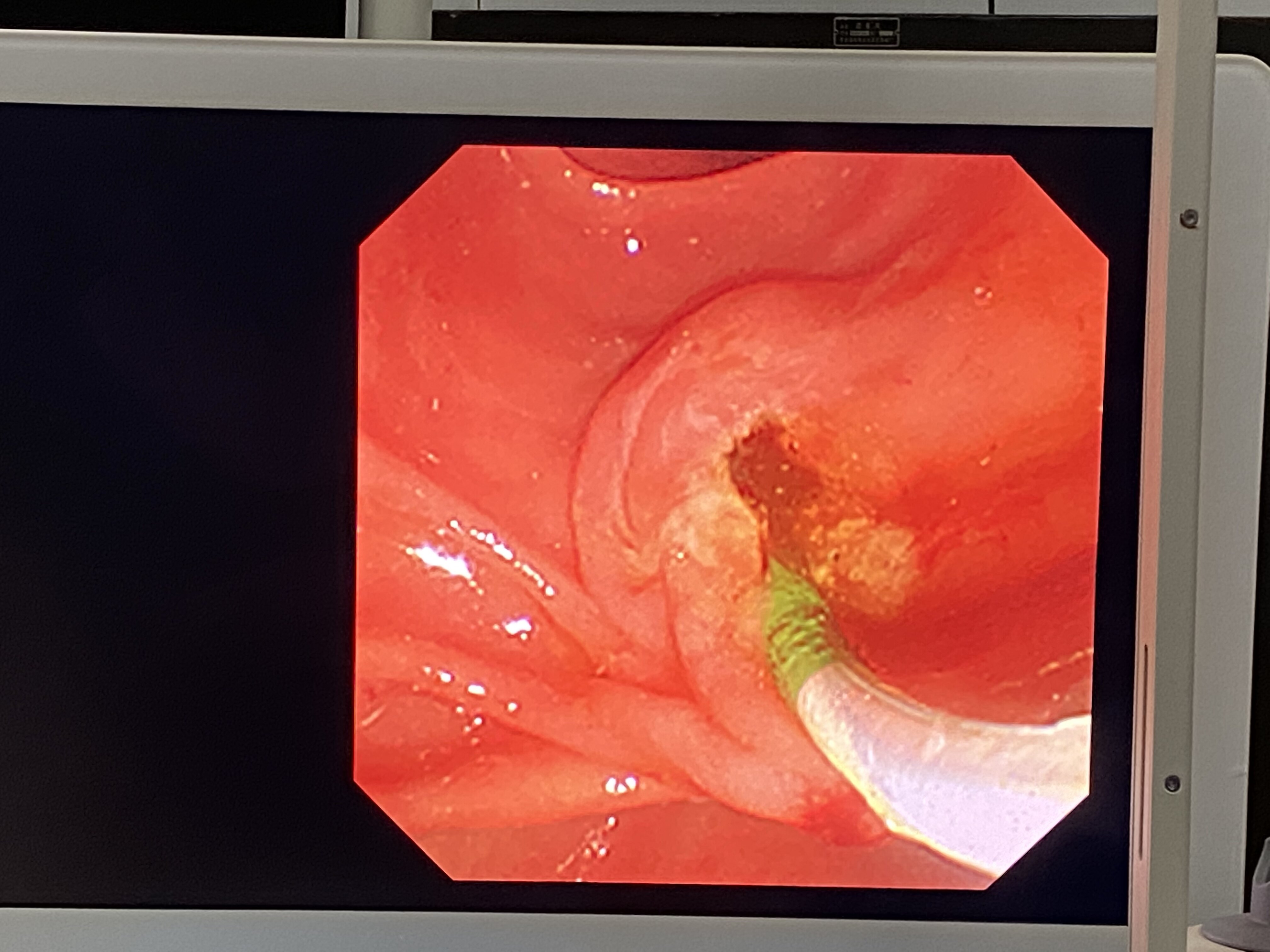 高位截瘫患者的胆管结石并化脓性感染的ercp取石 - 好大夫在线