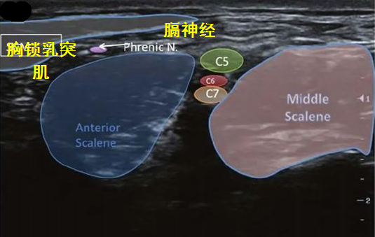 膈神经超声图图片