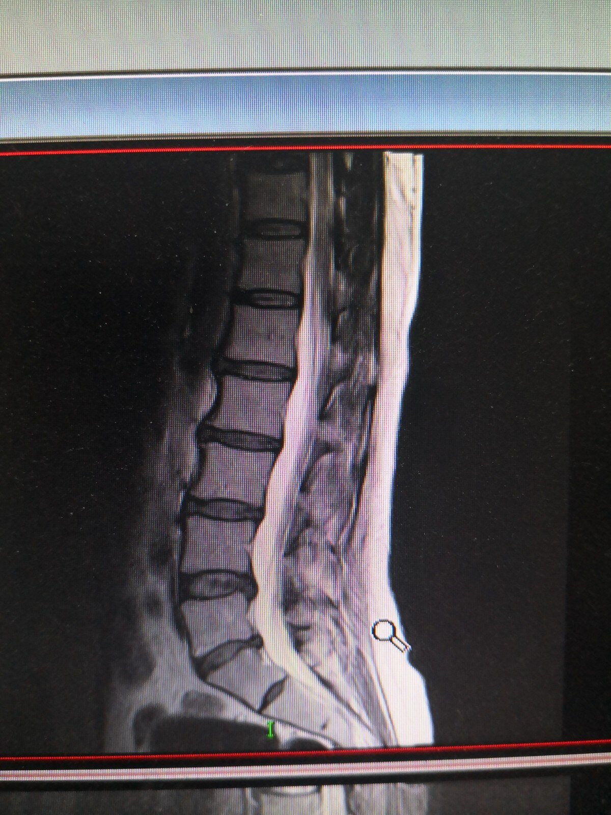 腰椎正侧位片:腰椎骨质增生,腰5骶1椎体后缘骨质增生,椎间隙变窄