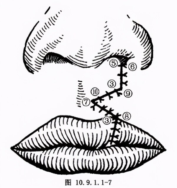 原則上單側唇裂,雙側唇裂都以這三種術式為主,諸如直線縫合修復術,z字