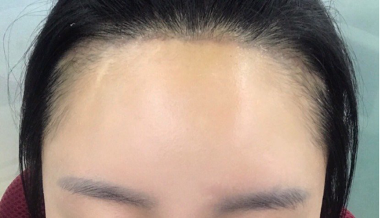 最恐怖的整形手术——额头缩小手术,为了美丽你会选择吗?