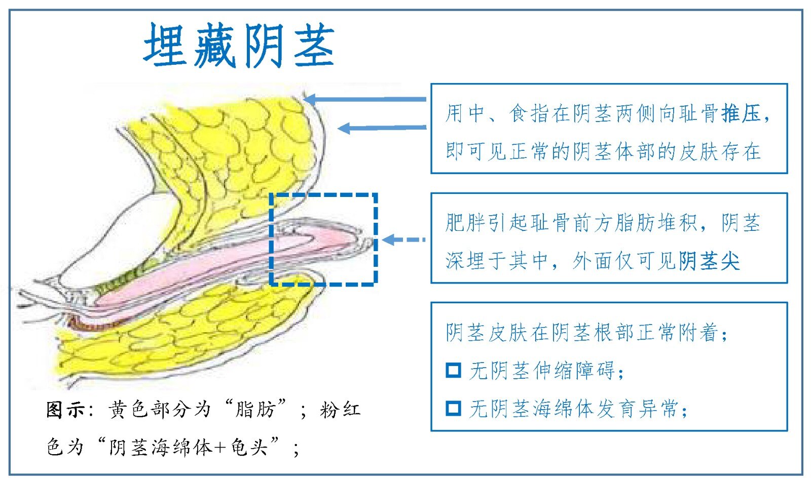 男性「阴茎短小」需要考虑这几种情况,有条件可手术整形