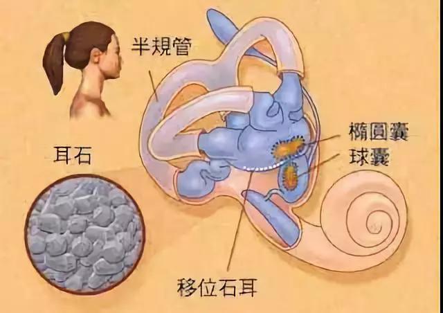 耳石症的正確處理