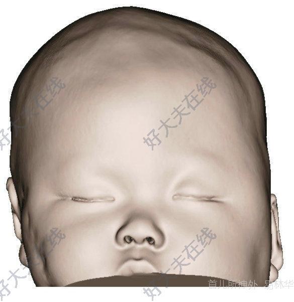 婴儿冠状缝图片