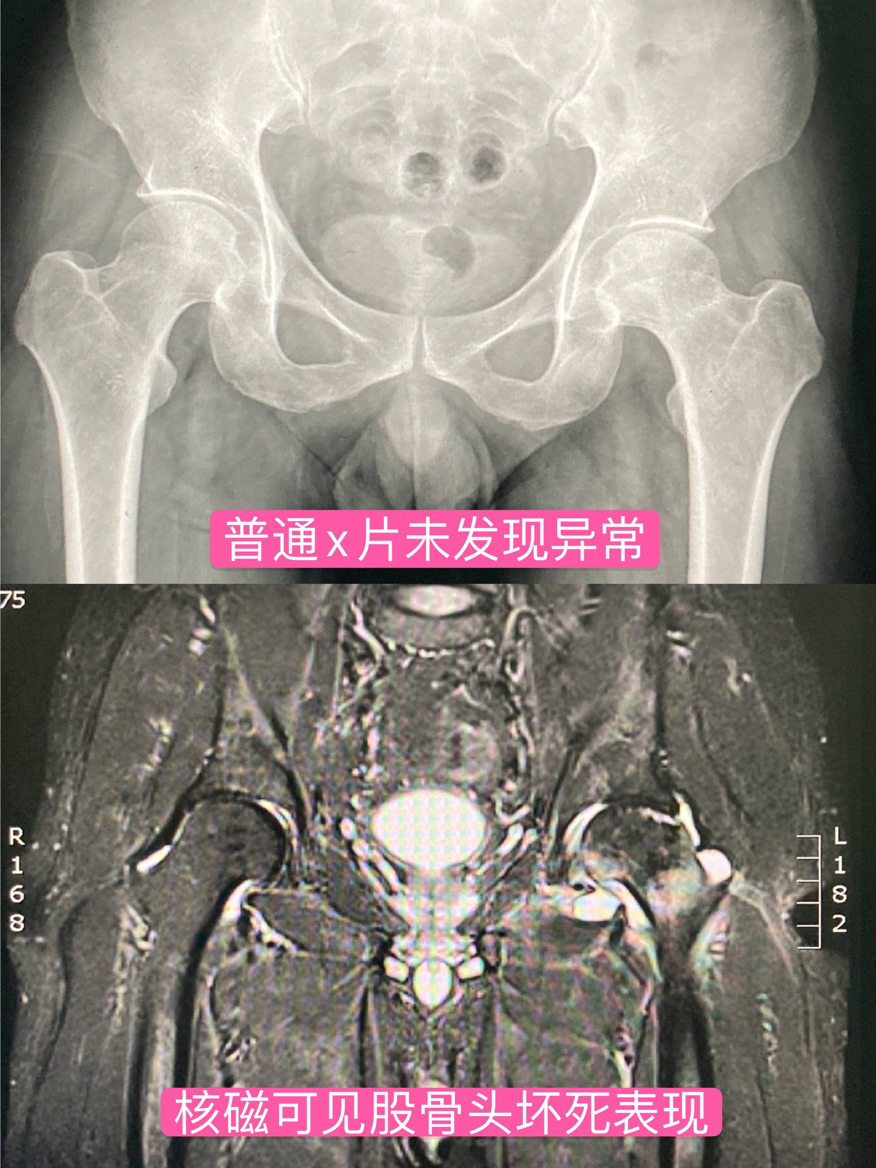 股骨头坏死MRI图片