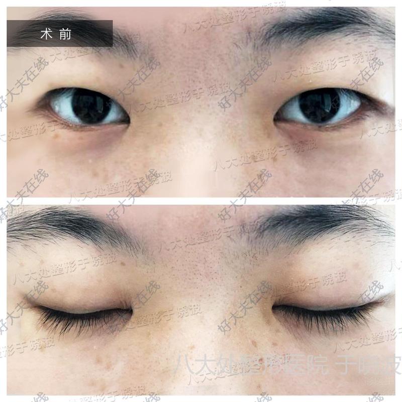 全切重睑_内眦赘皮 - 好大夫在线