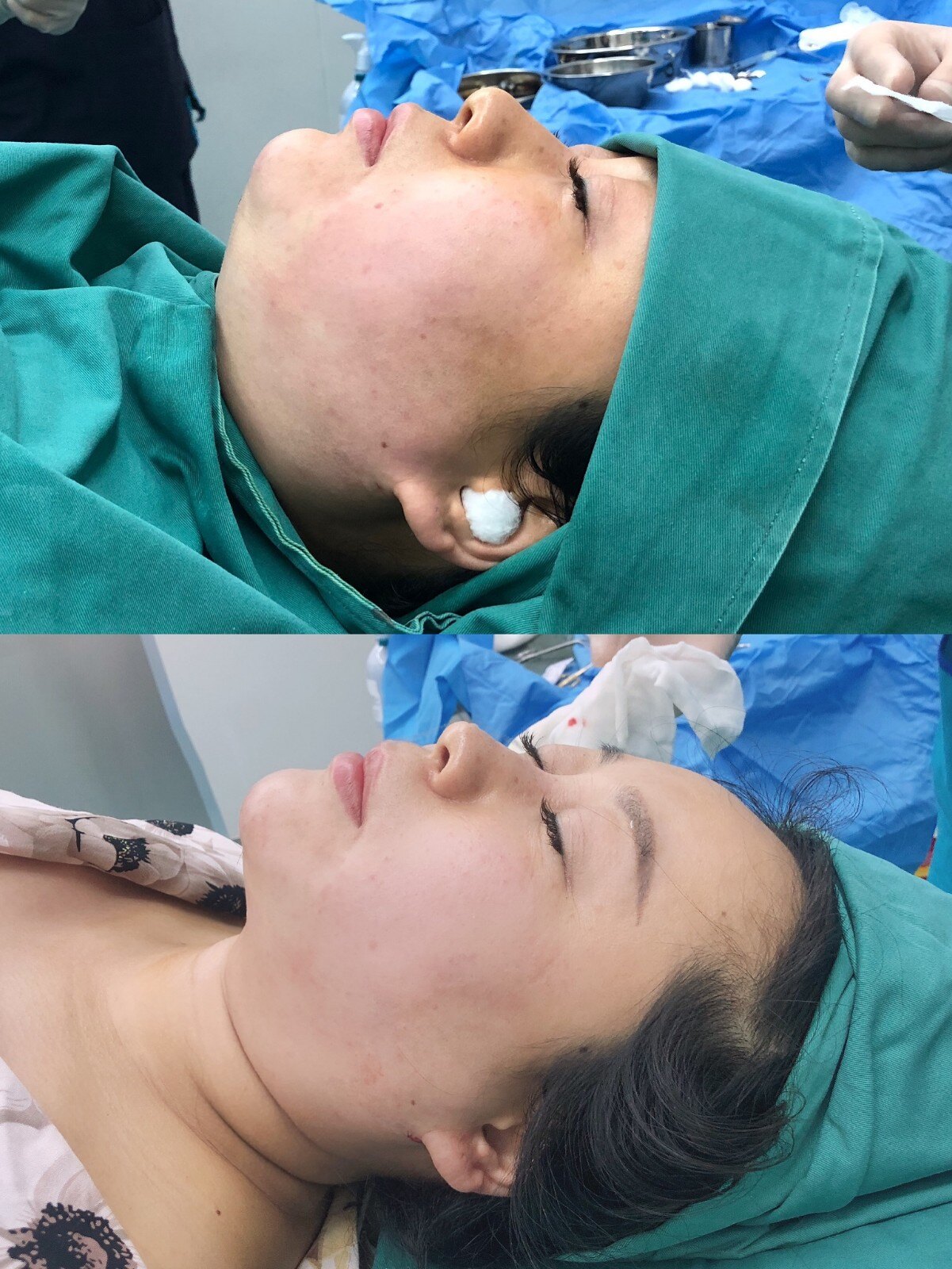 【刀锋论坛---吸脂】 维密脂雕治疗双下巴----微创,安全,快速,有效!