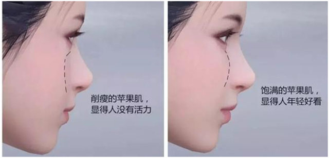 苹果肌凹陷,下垂该怎么解决?_注射美容 - 好大夫在线