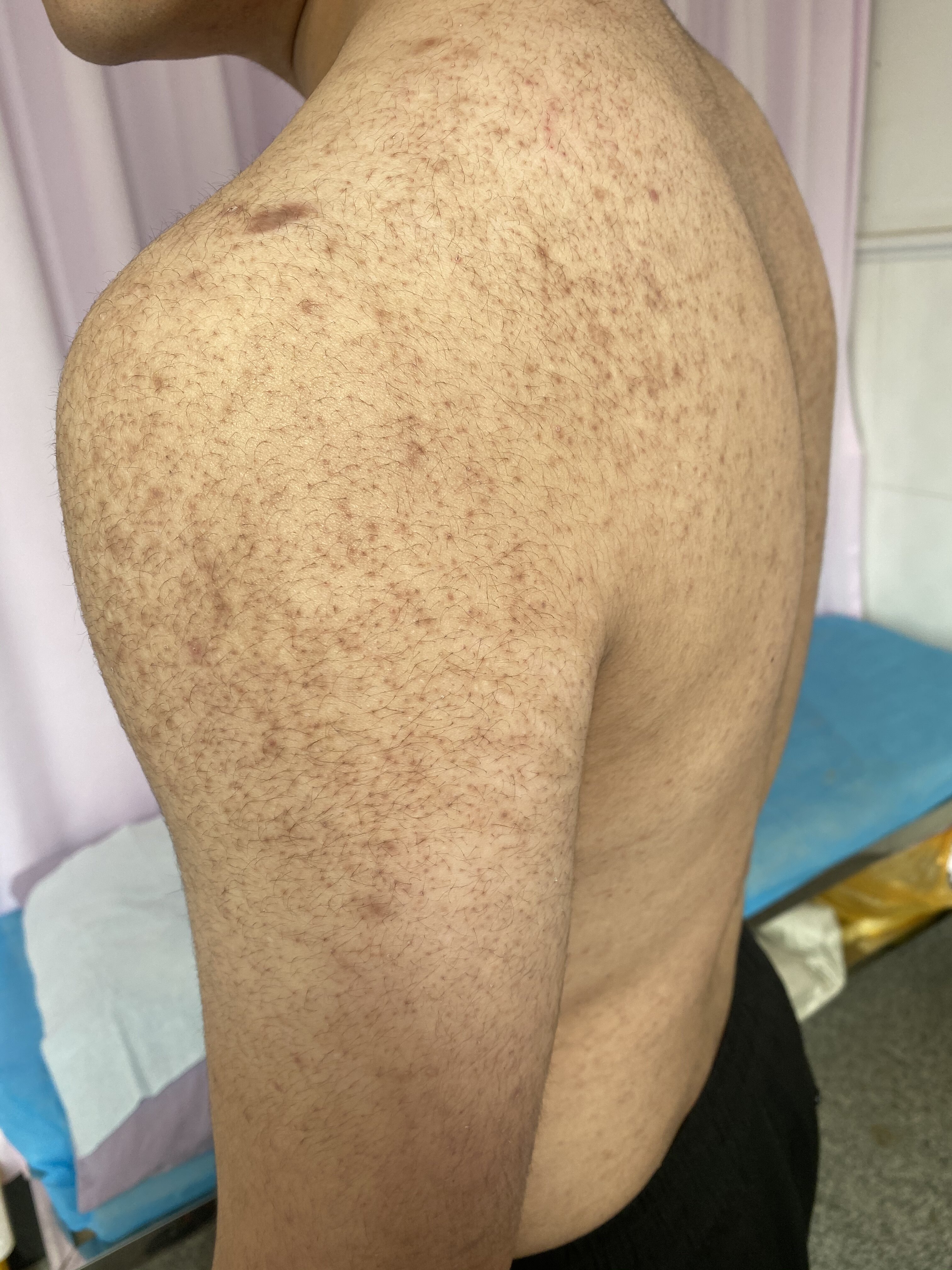 毛周角化俗称鸡皮肤(毛周角化就是鸡皮肤吗) 毛周角化俗称鸡皮肤(毛周角化就是鸡皮肤吗)