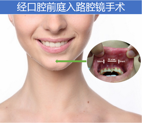 三种腔镜甲状腺癌微创手术方法比较